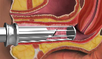 Гинекологичен лазер за хирургия и фракселна вагинална реювенация 